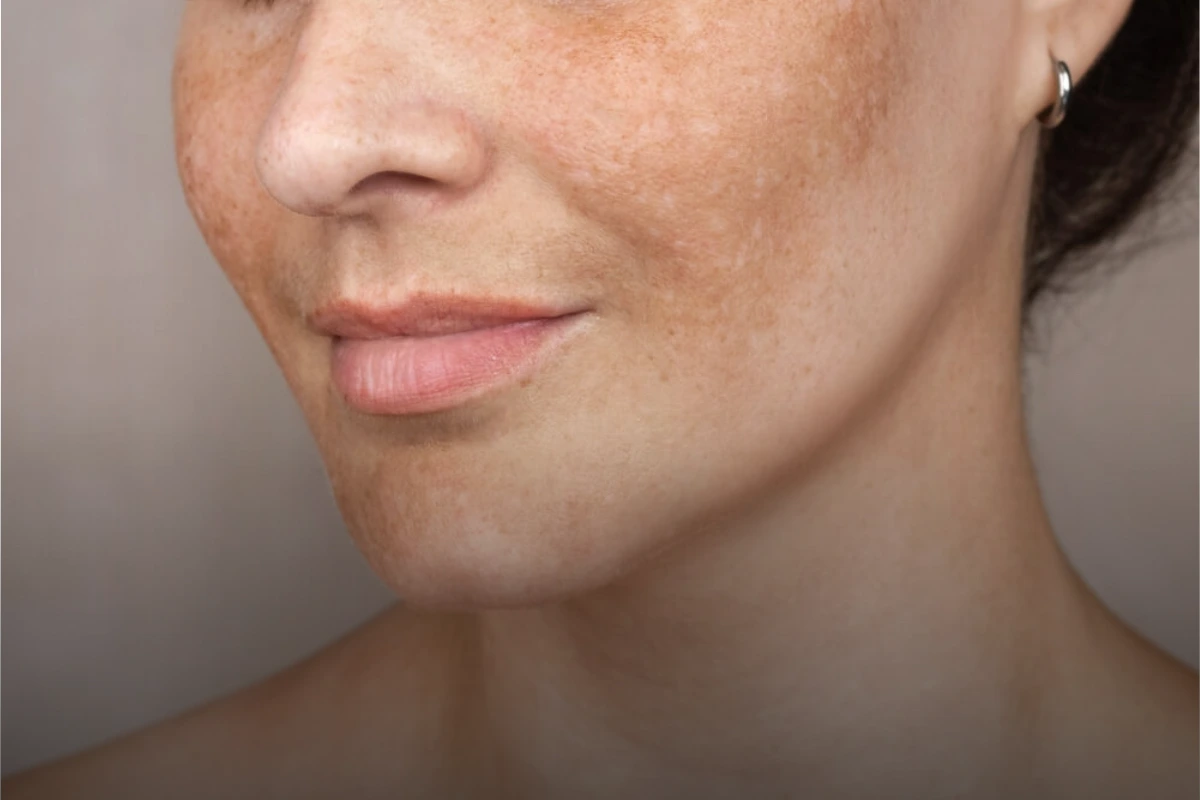 Melasma skin condition