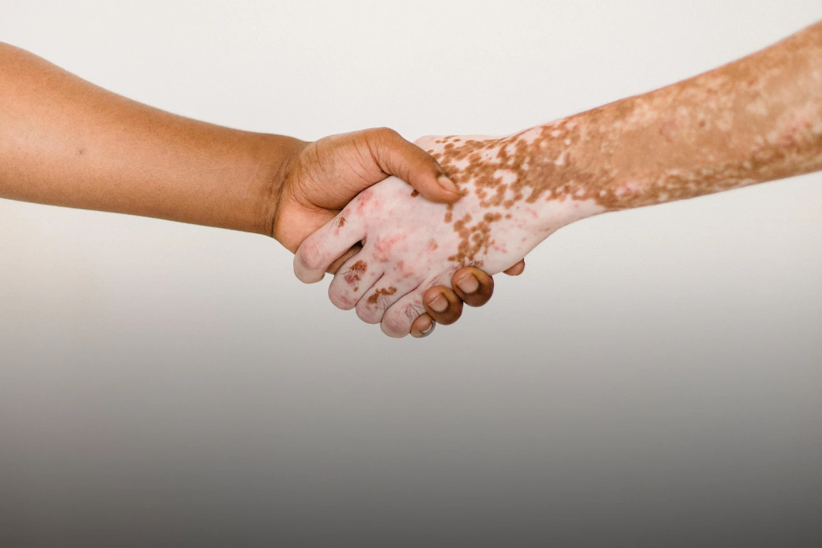 Vitiligo skin condition